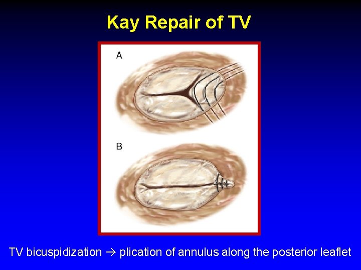 Kay Repair of TV TV bicuspidization plication of annulus along the posterior leaflet Kay Repair of TV TV bicuspidization plication of annulus along the posterior leaflet
