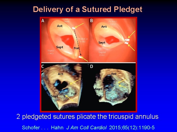 Delivery of a Sutured Pledget 2 pledgeted sutures plicate the tricuspid annulus Schofer. . Delivery of a Sutured Pledget 2 pledgeted sutures plicate the tricuspid annulus Schofer. .
