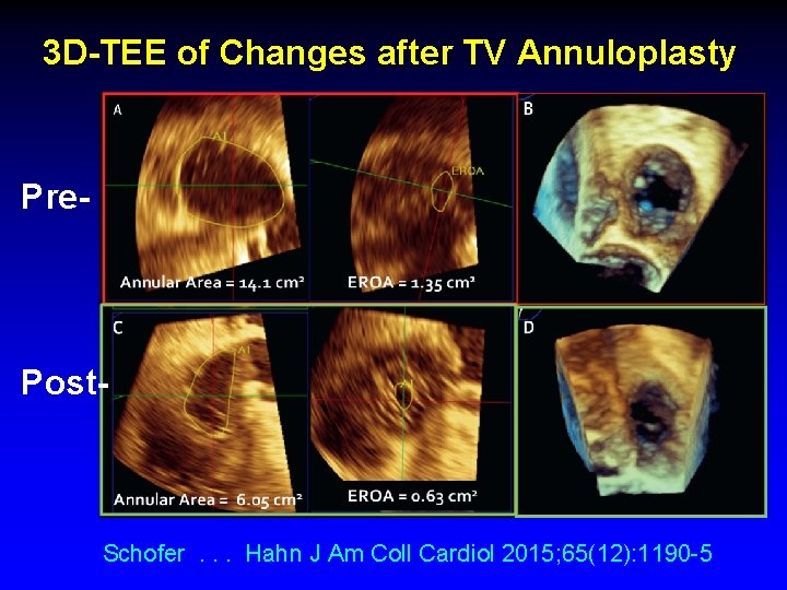3 D-TEE of Changes after TV Annuloplasty Pre- Post- Schofer. . . Hahn J 3 D-TEE of Changes after TV Annuloplasty Pre- Post- Schofer. . . Hahn J