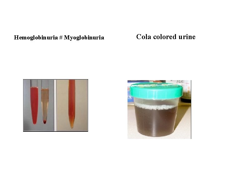Hemoglobinuria # Myoglobinuria Cola colored urine Hemoglobinuria # Myoglobinuria Cola colored urine