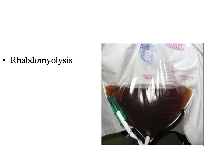 • Rhabdomyolysis • Rhabdomyolysis