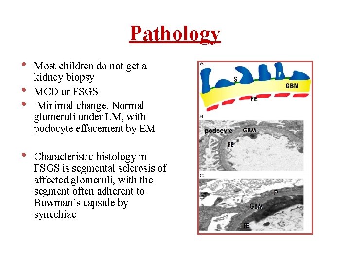 Pathology • • Most children do not get a kidney biopsy MCD or FSGS Pathology • • Most children do not get a kidney biopsy MCD or FSGS