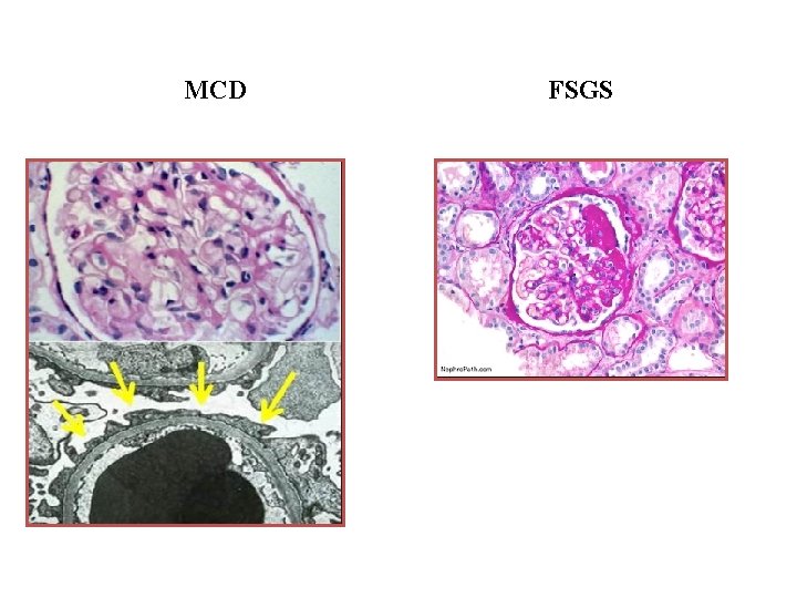 MCD FSGS MCD FSGS