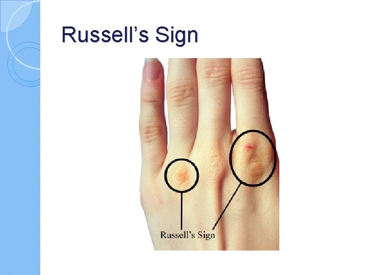 Russell’s Sign Russell’s Sign