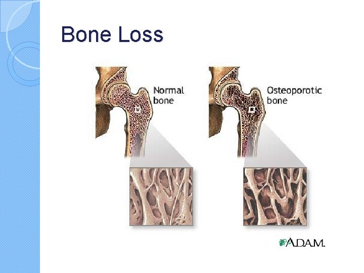 Bone Loss Bone Loss