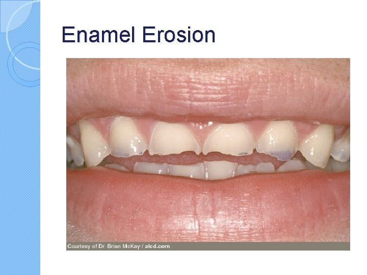 Enamel Erosion Enamel Erosion