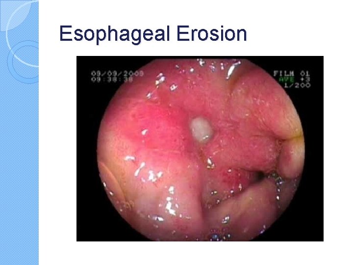 Esophageal Erosion Esophageal Erosion