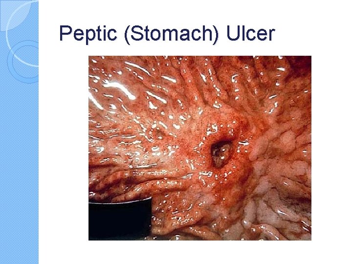 Peptic (Stomach) Ulcer Peptic (Stomach) Ulcer