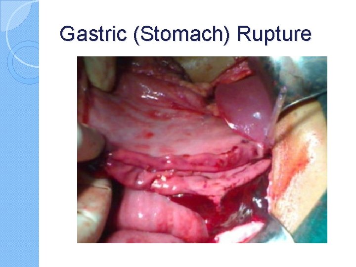 Gastric (Stomach) Rupture Gastric (Stomach) Rupture