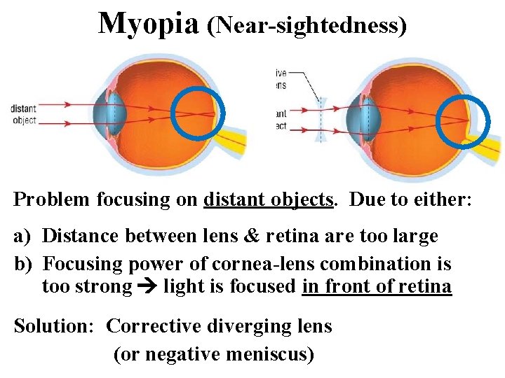 Myopia (Near-sightedness) Problem focusing on distant objects. Due to either: a) Distance between lens