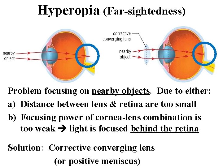 Hyperopia (Far-sightedness) Problem focusing on nearby objects. Due to either: a) Distance between lens