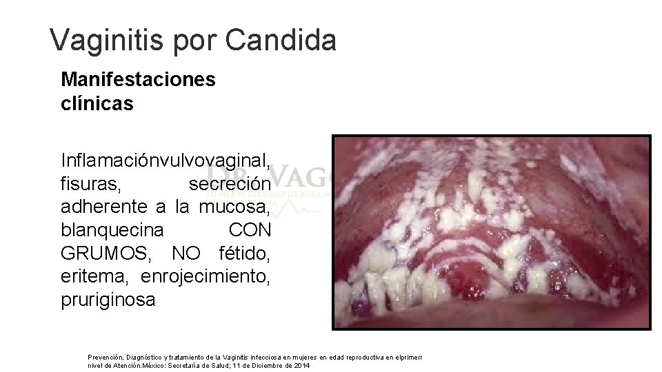 Vaginitis por Candida Manifestaciones clínicas Inflamación vulvovaginal, fisuras, secreción adherente a la mucosa, blanquecina Vaginitis por Candida Manifestaciones clínicas Inflamación vulvovaginal, fisuras, secreción adherente a la mucosa, blanquecina