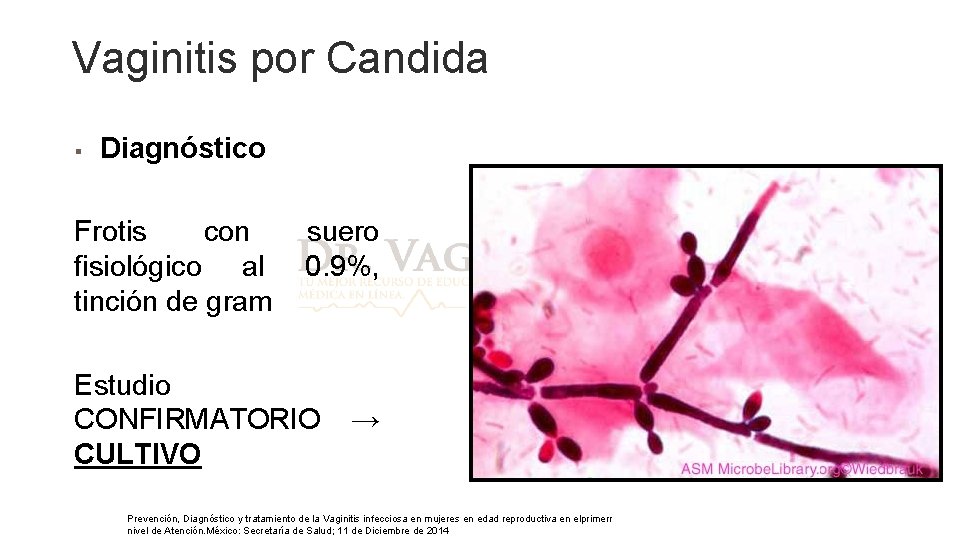 Vaginitis por Candida § Diagnóstico Frotis con fisiológico al tinción de gram suero 0. Vaginitis por Candida § Diagnóstico Frotis con fisiológico al tinción de gram suero 0.