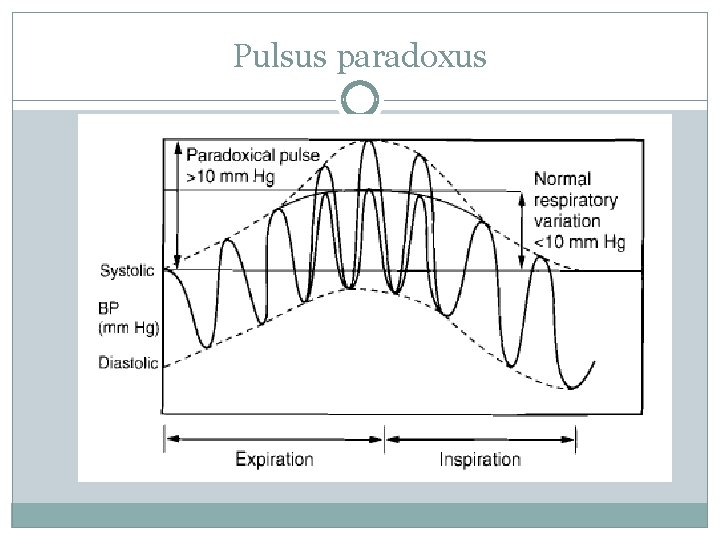 Pulsus paradoxus 