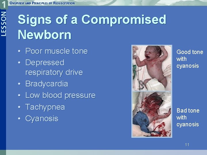 Signs of a Compromised Newborn • Poor muscle tone • Depressed respiratory drive •