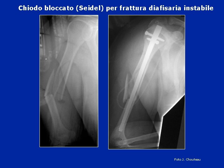 Chiodo bloccato (Seidel) per frattura diafisaria instabile Foto J. Chouteau 