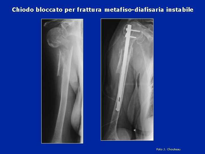 Chiodo bloccato per frattura metafiso-diafisaria instabile Foto J. Chouteau 