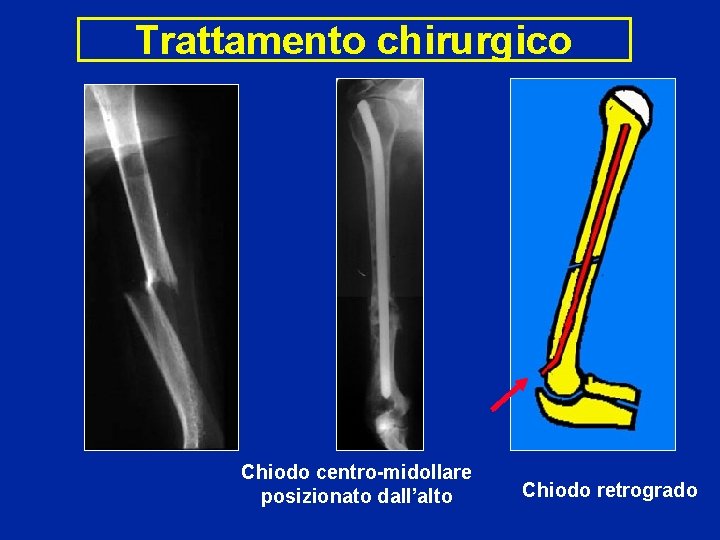 Trattamento chirurgico Chiodo centro-midollare posizionato dall’alto Chiodo retrogrado 