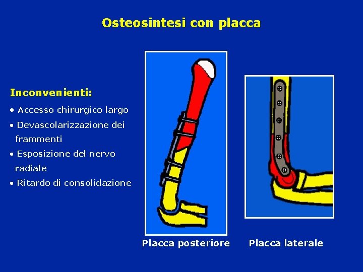 Osteosintesi con placca Inconvenienti: • Accesso chirurgico largo • Devascolarizzazione dei frammenti • Esposizione