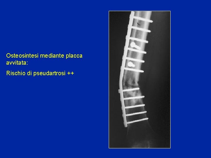 Osteosintesi mediante placca avvitata: Rischio di pseudartrosi ++ 