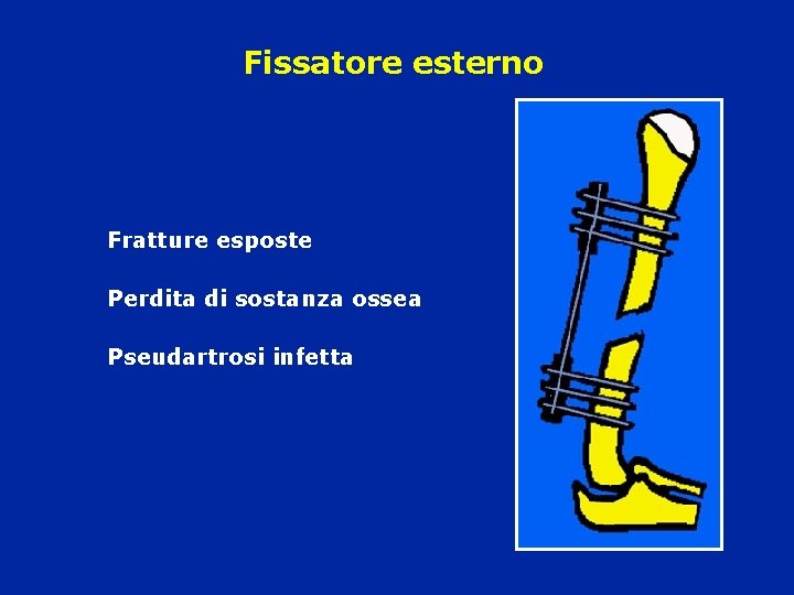 Fissatore esterno Fratture esposte Perdita di sostanza ossea Pseudartrosi infetta 