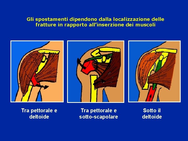 Gli spostamenti dipendono dalla localizzazione delle fratture in rapporto all’inserzione dei muscoli Tra pettorale