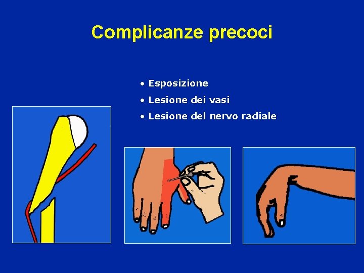 Complicanze precoci • Esposizione • Lesione dei vasi • Lesione del nervo radiale 