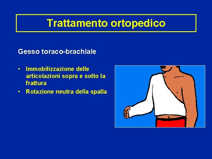 Trattamento ortopedico Gesso toraco-brachiale • Immobilizzazione delle articolazioni sopra e sotto la frattura •