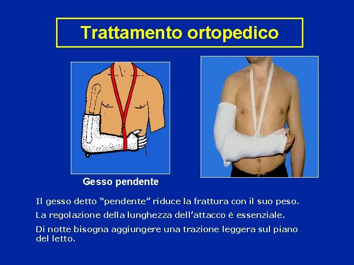 Trattamento ortopedico Gesso pendente Il gesso detto “pendente” riduce la frattura con il suo