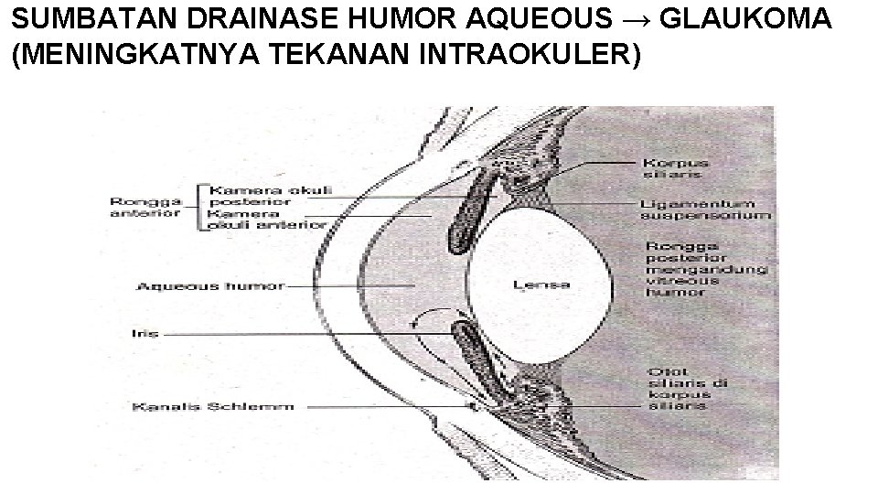 SUMBATAN DRAINASE HUMOR AQUEOUS → GLAUKOMA (MENINGKATNYA TEKANAN INTRAOKULER) 