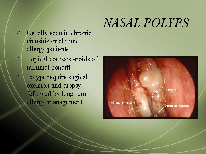  Usually seen in chronic sinusitis or chronic allergy patients Topical corticosteroids of minimal