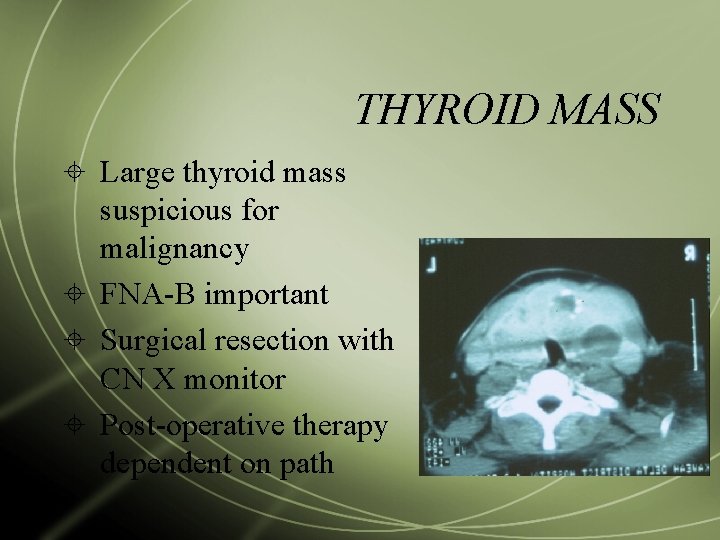 THYROID MASS Large thyroid mass suspicious for malignancy FNA-B important Surgical resection with CN