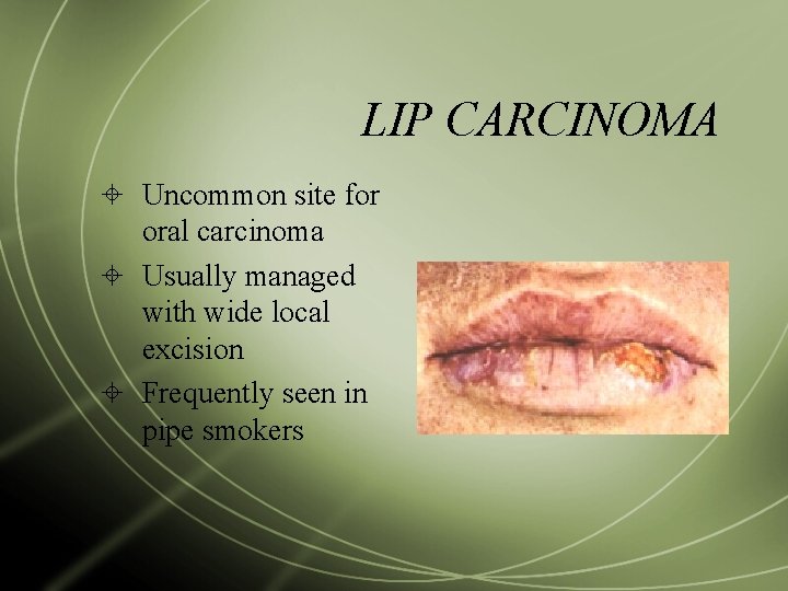 LIP CARCINOMA Uncommon site for oral carcinoma Usually managed with wide local excision Frequently