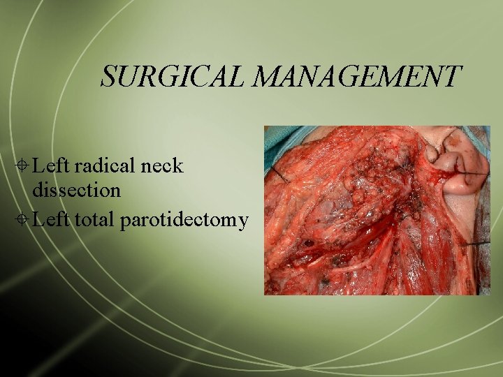 SURGICAL MANAGEMENT Left radical neck dissection Left total parotidectomy 