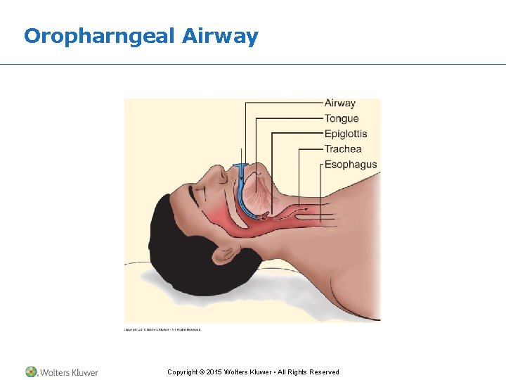 Oropharngeal Airway Copyright © 2015 Wolters Kluwer • All Rights Reserved 