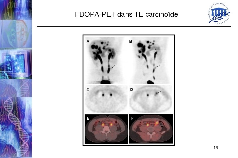 FDOPA-PET dans TE carcinoïde 16 