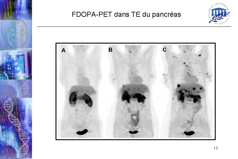 FDOPA-PET dans TE du pancréas 17 