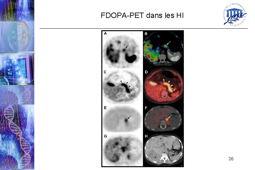 FDOPA-PET dans les HI 26 