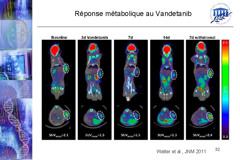 Réponse métabolique au Vandetanib Walter et al. , JNM 2011 32 