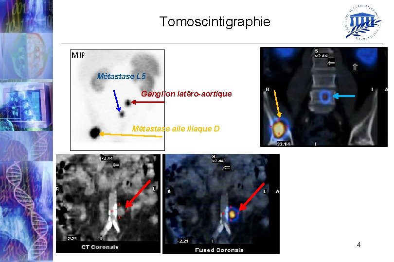 Tomoscintigraphie MIP Métastase L 5 Ganglion latéro-aortique Métastase aile iliaque D 4 