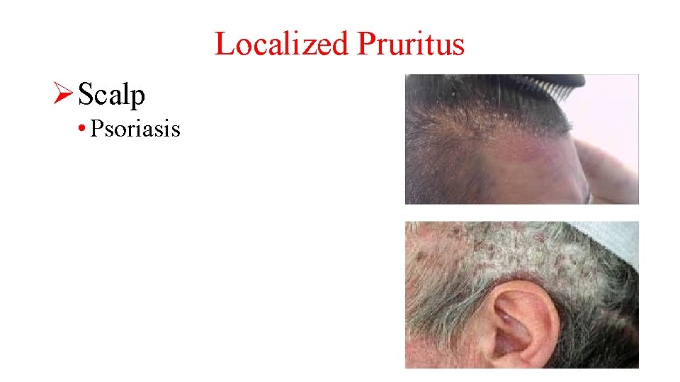 Localized Pruritus ØScalp • Psoriasis 