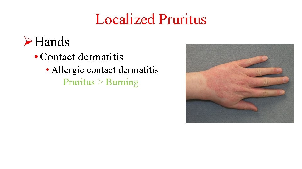 Localized Pruritus ØHands • Contact dermatitis • Allergic contact dermatitis Pruritus > Burning 