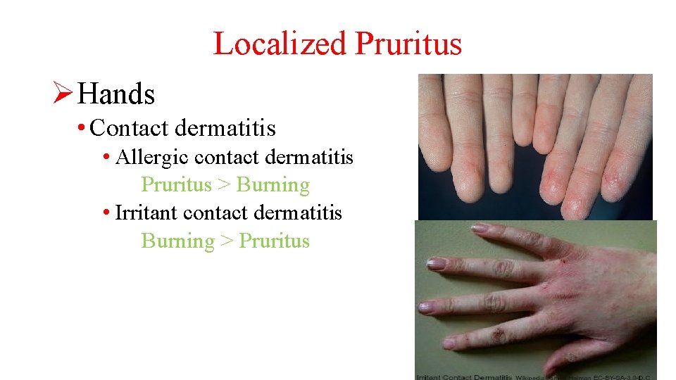 Localized Pruritus ØHands • Contact dermatitis • Allergic contact dermatitis Pruritus > Burning •