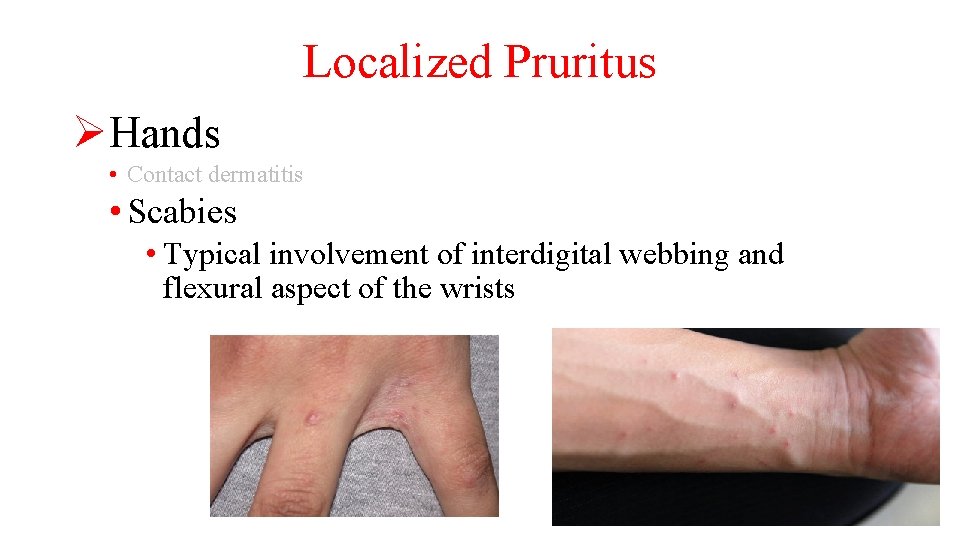 Localized Pruritus ØHands • Contact dermatitis • Scabies • Typical involvement of interdigital webbing