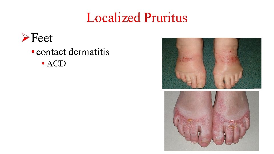 Localized Pruritus ØFeet • contact dermatitis • ACD 