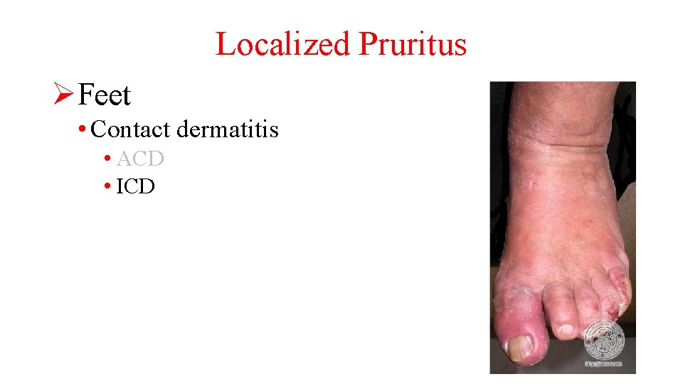 Localized Pruritus ØFeet • Contact dermatitis • ACD • ICD 