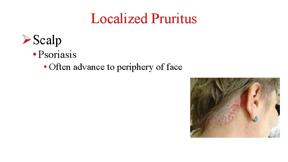 Localized Pruritus ØScalp • Psoriasis • Often advance to periphery of face 