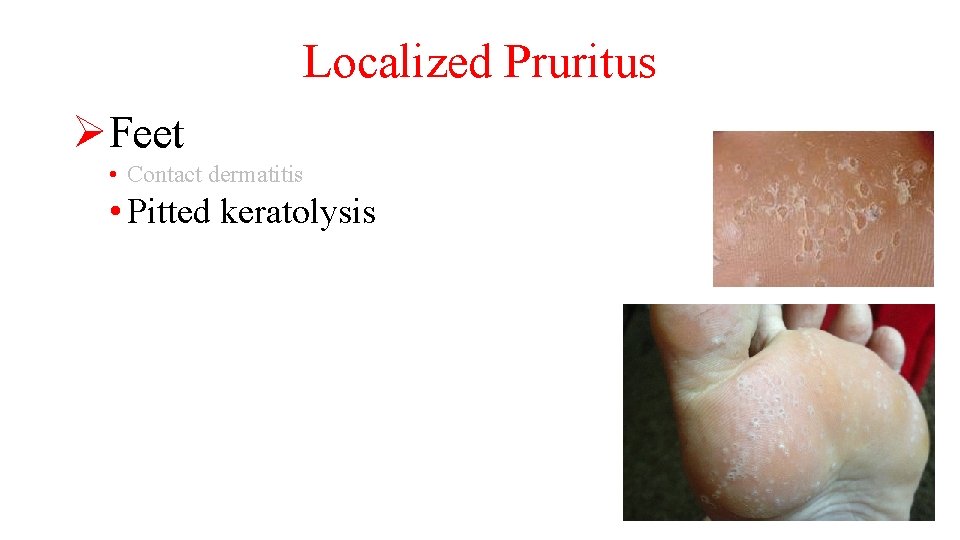 Localized Pruritus ØFeet • Contact dermatitis • Pitted keratolysis 