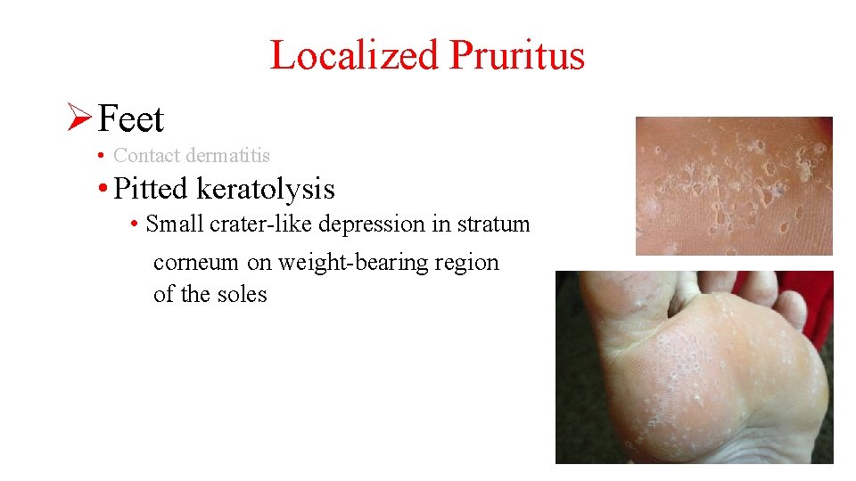 Localized Pruritus ØFeet • Contact dermatitis • Pitted keratolysis • Small crater-like depression in