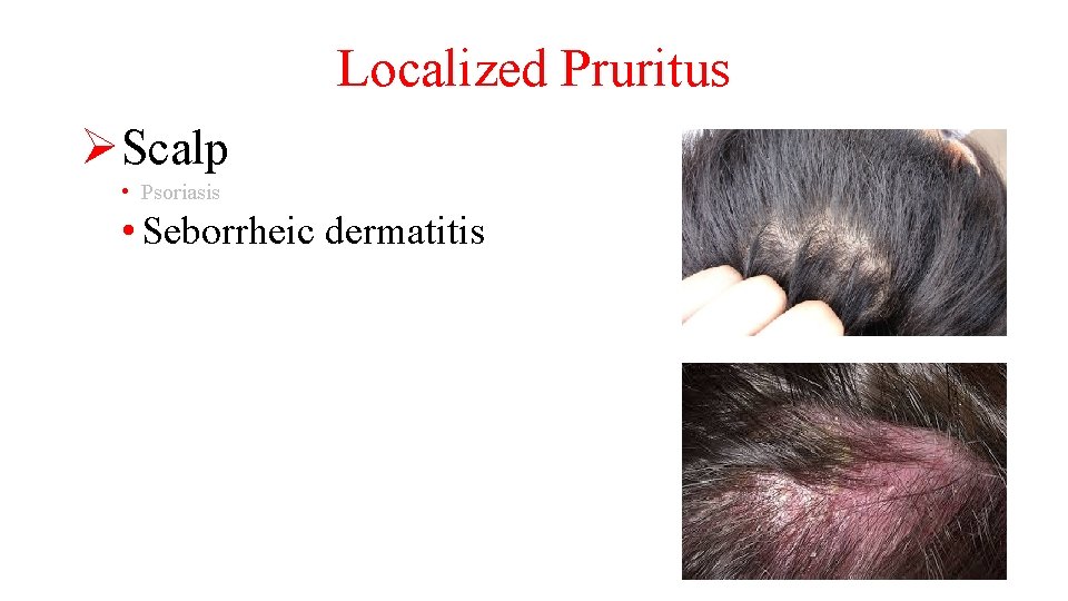 Localized Pruritus ØScalp • Psoriasis • Seborrheic dermatitis 